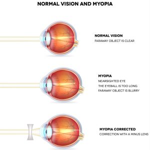 Myopia and Normal Vision